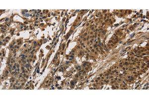 Immunohistochemistry of paraffin-embedded Human gasrtic cancer tissue using CCAR1 Polyclonal Antibody at dilution 1:40 (CCAR1 anticorps)