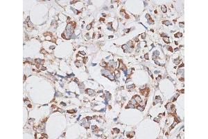 Immunohistochemistry of paraffin-embedded Human breast cancer using KIF14 Polyclonal Antibody at dilution of 1:100 (40x lens). (KIF14 anticorps)