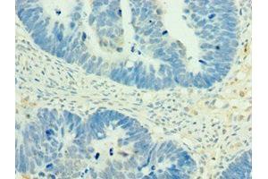 Immunohistochemistry of paraffin-embedded human ovarian cancer using ABIN7160504 at dilution of 1:100 (MEF2C anticorps  (AA 170-380))