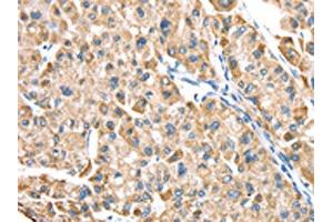 The image on the left is immunohistochemistry of paraffin-embedded Human liver cancer tissue using ABIN7191329(LTB4R2 Antibody) at dilution 1/20, on the right is treated with synthetic peptide. (LTB4R2 anticorps)