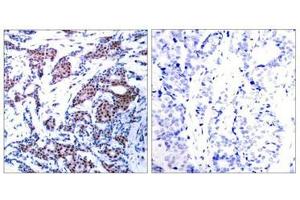 Immunohistochemical analysis of paraffin-embedded human breast carcinoma tissue using c-Jun(Phospho-Ser73) Antibody(left) or the same antibody preincubated with blocking peptide(right).