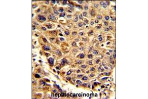 Formalin-fixed and paraffin-embedded human hepatocarcinoma reacted with SPCS3 Antibody , which was peroxidase-conjugated to the secondary antibody, followed by DAB staining. (SPCS3 anticorps  (C-Term))
