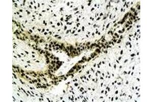 Immunohistochemiacl staining of human gastric carcinoma tissue section with CYC1 polyclonal antibody  at 1:500 dilution. (Cytochrome C1 anticorps)