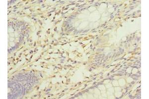 Immunohistochemistry of paraffin-embedded human colon cancer using ABIN7175519 at dilution of 1:100 (Vinexin anticorps  (AA 1-329))