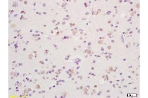 Formalin-fixed and paraffin embedded human glioma tissue labeled with Anti phospho-Dnmt1(Ser154) Polyclonal Antibody, Unconjugated (ABIN757717) at 1:200 followed by conjugation to the secondary antibody and DAB staining