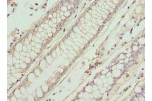 Immunohistochemistry of paraffin-embedded human colon cancer using ABIN7156584 at dilution of 1:100 (IFNB1 anticorps  (AA 22-187))