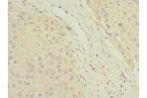 Immunohistochemistry of paraffin-embedded human liver cancer using ABIN7154846 at dilution of 1:100 (HAND2 anticorps  (AA 1-217))