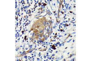 Immunohistochemistry of paraffin-embedded human lung cancer using Argonaute-2 antibody (ABIN7265671) at dilution of 1:100 (40x lens). (AGO2 anticorps)