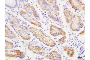 Formalin-fixed and paraffin embedded human gastric carcinoma labeled with Anti-Anei-ATX/Autotaxin Polyclonal Antibody, Unconjugated (ABIN740265) at 1:200 followed by conjugation to the secondary antibody