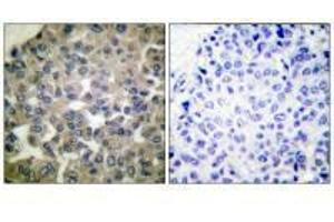 Immunohistochemical analysis of paraffin-embedded human breast carcinoma tissue using PLCG1 (Ab-771) antibody.