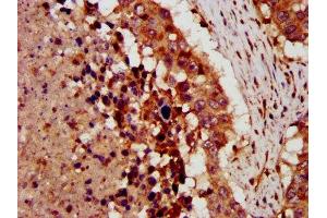 IHC image of ABIN7149298 diluted at 1:300 and staining in paraffin-embedded human lung cancer performed on a Leica BondTM system. (CRLF1 anticorps  (AA 318-422))