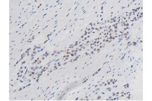 ABIN6267508 at 1/200 staining Human bladder cancer tissue sections by IHC-P.