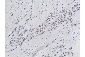 ABIN6267508 at 1/200 staining Human bladder cancer tissue sections by IHC-P. (STAT1 anticorps  (pSer727))