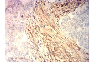 Immunohistochemical analysis of paraffin-embedded cervical cancer tissues using CNN3 mouse mAb with DAB staining.