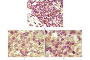 Immunohistochemical analysis of paraffin-embedded human lymphoid (A), ovary tumor (B) and testicle tumor (C) tissues using INHA mouse mAb with DAB staining. (Inhibin alpha anticorps)