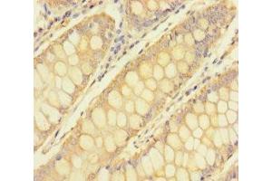 Immunohistochemistry of paraffin-embedded human colon cancer using ABIN7173639 at dilution of 1:100 (TULP3 anticorps  (AA 1-260))