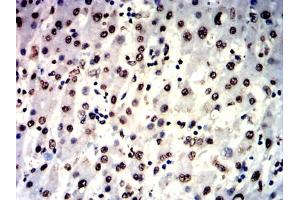 Immunohistochemical analysis of paraffin-embedded liver cancer tissues using IL1B mouse mAb with DAB staining.