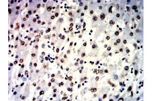 Immunohistochemical analysis of paraffin-embedded liver cancer tissues using IL1B mouse mAb with DAB staining. (IL-1 beta anticorps  (AA 117-269))