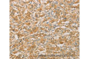 Immunohistochemistry of Human gastric cancer using PRPSAP1 Polyclonal Antibody at dilution of 1:50