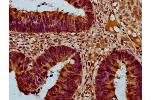 IHC image of ABIN7172073 diluted at 1:400 and staining in paraffin-embedded human ovarian cancer performed on a Leica BondTM system.