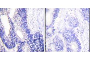 Immunohistochemical analysis of paraffin-embedded human colon carcinoma tissue using Claudin 3 antibody. (Claudin 3 anticorps)