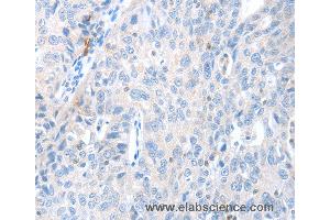 Immunohistochemistry of Human ovarian cancer using MAGEB4 Polyclonal Antibody at dilution of 1:40 (MAGEB4 anticorps)