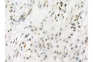 ABIN6263640 and ABIN6272364 at 1/100 staining human gastric carcinoma by IHC-P.