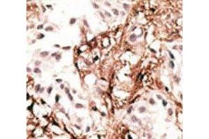 IHC analysis of FFPE human breast carcinoma tissue stained with the LC3C antibody (LC3C anticorps  (AA 1-30))