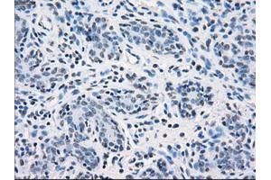 Immunohistochemical staining of paraffin-embedded breast tissue using anti-SORD mouse monoclonal antibody. (SORD anticorps)