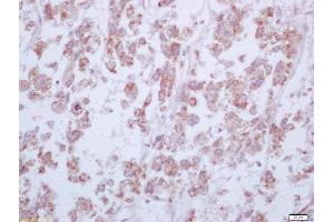 Formalin-fixed and paraffin embedded human liver carcinoma labeled with Anti-Arginase 1 Polyclonal Antibody, Unconjugated  at 1:200 followed by conjugation to the secondary antibody and DAB staining (Liver Arginase anticorps  (AA 151-220))