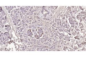 Paraformaldehyde-fixed, paraffin embedded Human pancreatic cancer; Antigen retrieval by boiling in sodium citrate buffer (pH6.