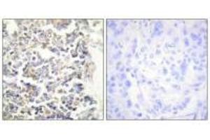 Immunohistochemistry analysis of paraffin-embedded human lung carcinoma tissue using MARK3 antibody. (MARK3 anticorps  (N-Term))
