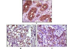 Immunohistochemical analysis of paraffin-embedded human breast tissue (A), lymph tissue (B) and skin carcinoma (C), showing membrane localization using BLK mouse mAb with DAB staining.