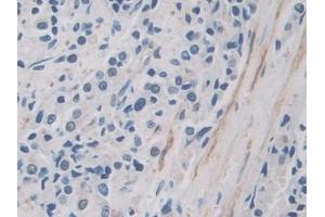 Detection of ITIH1 in Human Prostate cancer Tissue using Polyclonal Antibody to Inter Alpha-Globulin Inhibitor H1 (ITIH1) (ITIH1 anticorps  (AA 507-819))