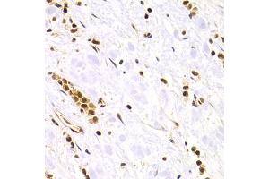 Immunohistochemistry of paraffin-embedded human gastric cancer using RAD50 Antibody. (RAD50 anticorps)