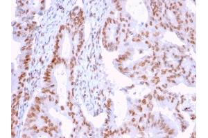 Formalin-fixed, paraffin-embedded human Breast Carcinoma stained with CLEC9A Mouse Monoclonal Antibody (2H12/4).