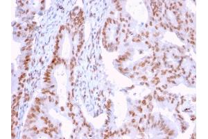 Formalin-fixed, paraffin-embedded human Breast Carcinoma stained with CLEC9A Mouse Monoclonal Antibody (2H12/4). (DMC1 anticorps)