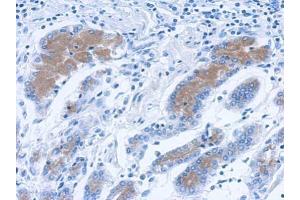 IHC-P Image Immunohistochemical analysis of paraffin-embedded human colon carcinoma, using Annexin II antibody, antibody at 1:500 dilution. (Annexin A2 anticorps)