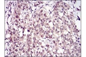 Immunohistochemical analysis of paraffin-embedded human bladder cancer tissues using RANBP9 mouse mAb with DAB staining. (Importin 9 anticorps  (AA 453-680))