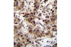 ZNF321 Antibody (N-term) immunohistochemistry analysis in formalin fixed and paraffin embedded human breast carcinoma followed by peroxidase conjugation of the secondary antibody and DAB staining. (ZNF321P anticorps  (N-Term))