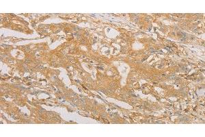 Immunohistochemistry of paraffin-embedded Human gastric cancer tissue using CD40 Polyclonal Antibody at dilution 1:70 (CD40 anticorps)