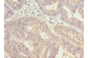 Immunohistochemistry of paraffin-embedded human endometrial cancer using ABIN7143769 at dilution of 1:100 (ALG2 anticorps  (AA 197-416))