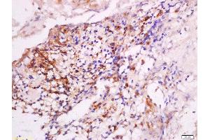 Formalin-fixed and paraffin embedded human laryngocarcinoma labeled with Anti-DNase II Polyclonal Antibody, Unconjugated  at 1:200 followed by conjugation to the secondary antibody and DAB staining.