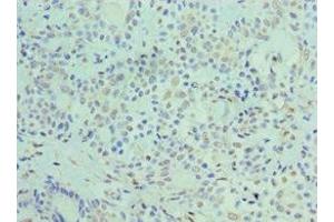 Immunohistochemistry of paraffin-embedded human breast cancer using ABIN7162890 at dilution of 1:100