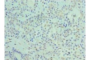 Immunohistochemistry of paraffin-embedded human breast cancer using ABIN7162890 at dilution of 1:100 (ADRP anticorps  (AA 168-437))