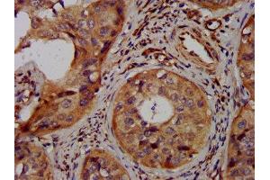 IHC image of ABIN7158788 diluted at 1:300 and staining in paraffin-embedded human cervical cancer performed on a Leica BondTM system.