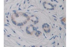 Detection of CYP21A2 in Human Pancreatic cancer Tissue using Polyclonal Antibody to Cytochrome P450 Family 21 Subfamily A Member 2 (CYP21A2)