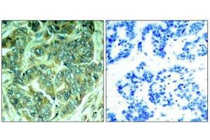 Immunohistochemical analysis of paraffin-embedded human breast carcinoma tissue using p62Dok(Phospho-Tyr398) Antibody(left) or the same antibody preincubated with blocking peptide(right).