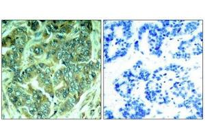 Immunohistochemical analysis of paraffin-embedded human breast carcinoma tissue using p62Dok(Phospho-Tyr398) Antibody(left) or the same antibody preincubated with blocking peptide(right). (DOK1 anticorps  (pTyr398))
