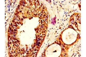 IHC image of ABIN7169337 diluted at 1:500 and staining in paraffin-embedded human cervical cancer performed on a Leica BondTM system.